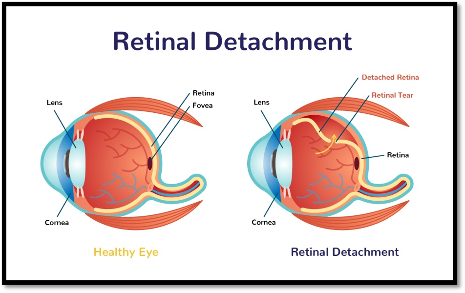 What Causes Retinal Detachment?